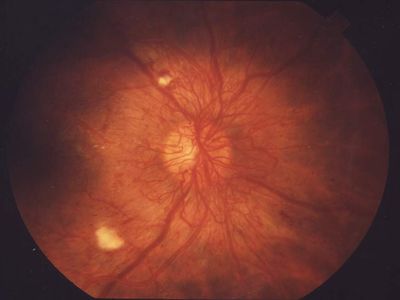 Fundus photo