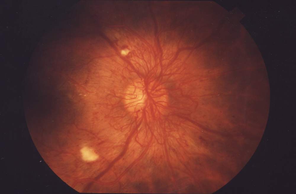 Colour fundus photograph of the right eye, centred on the optic disc